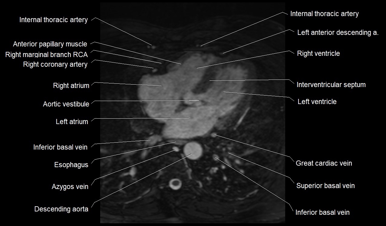 MRI heart coronary arteries and coronary veins anatomy axial image 28.jpg